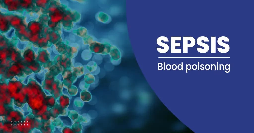 What Is Sepsis? - Stages, Causes, Symptoms and more