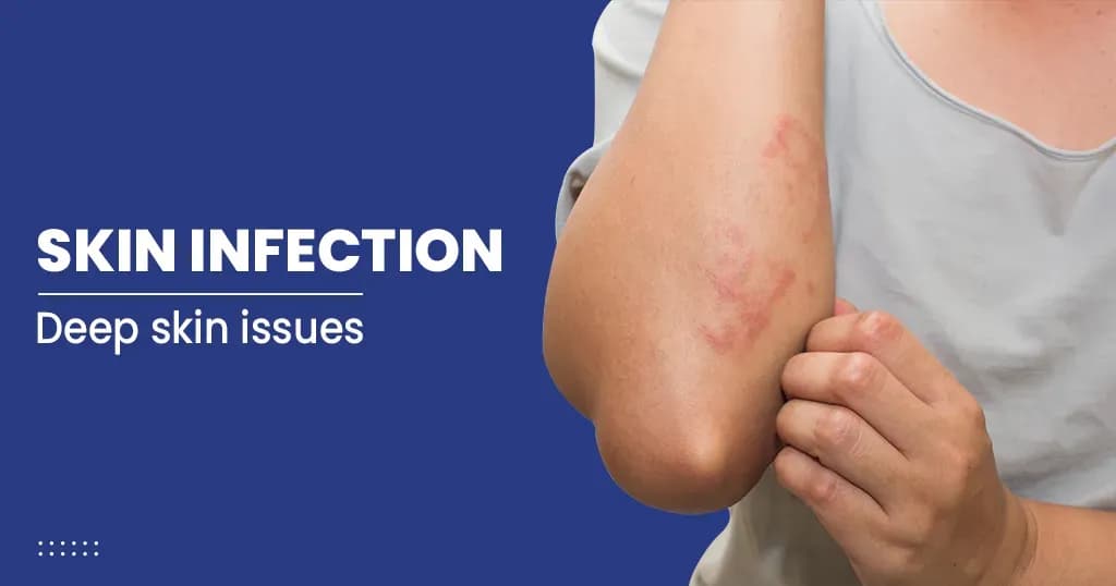 Skin infection – Causes, Symptoms, Treatments, and Risk factors