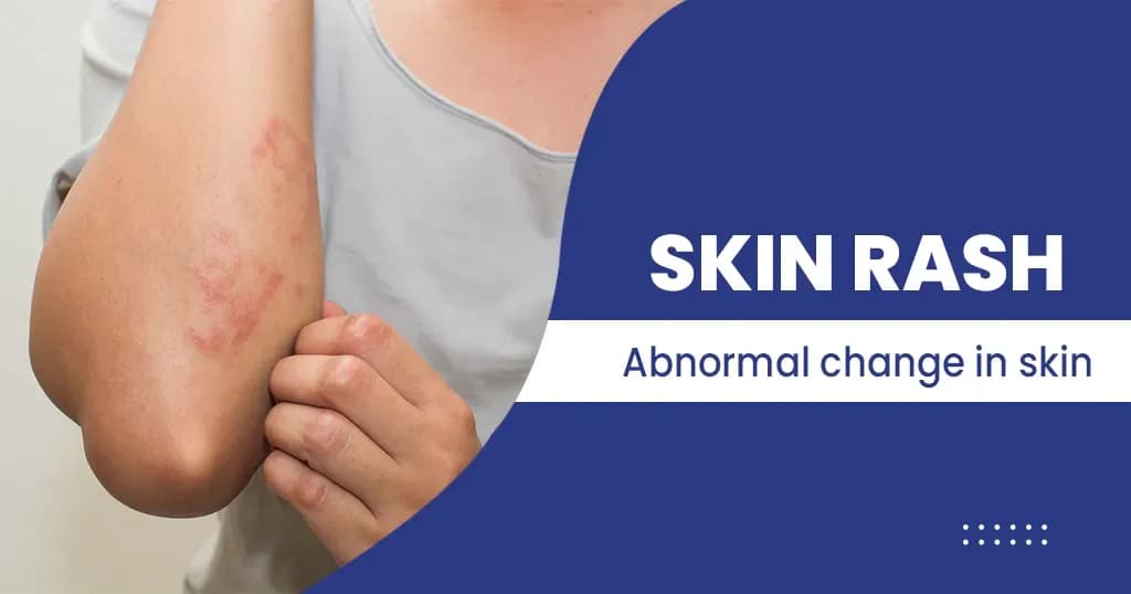 Skin Rash - Types, Causes, Tests and more