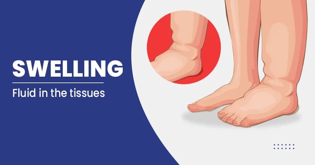 Swelling – Symptoms, Causes and Treatments