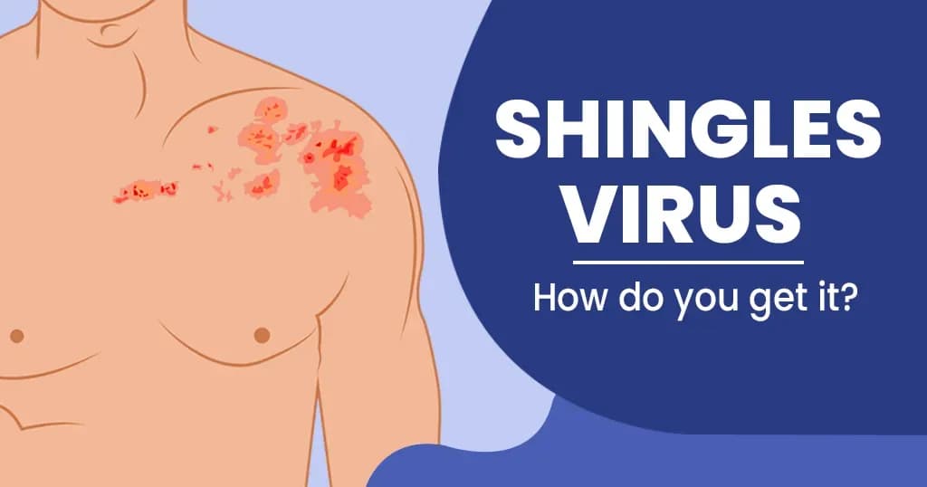 Shingles virus — Causes, symptoms,treatment