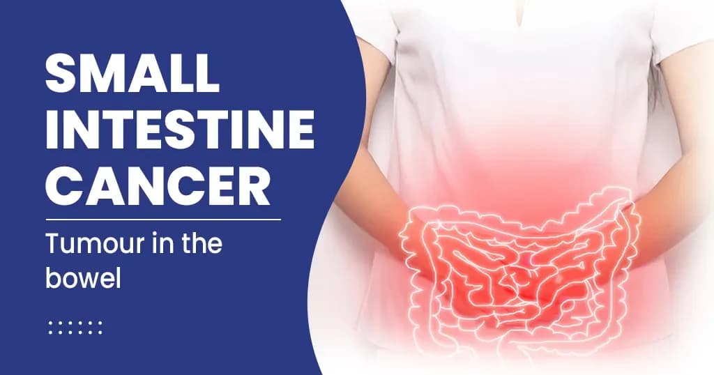 Small Intestine Cancer - Types, Symptoms, Diagnosis and Treatment