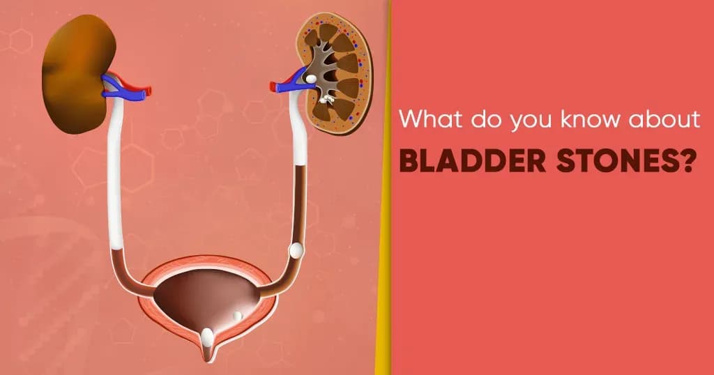 Bladder stones - Symptoms, causes, diagnosis, treatment