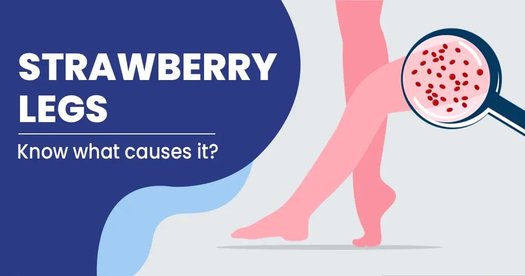 Strawberry legs - Causes and treatment