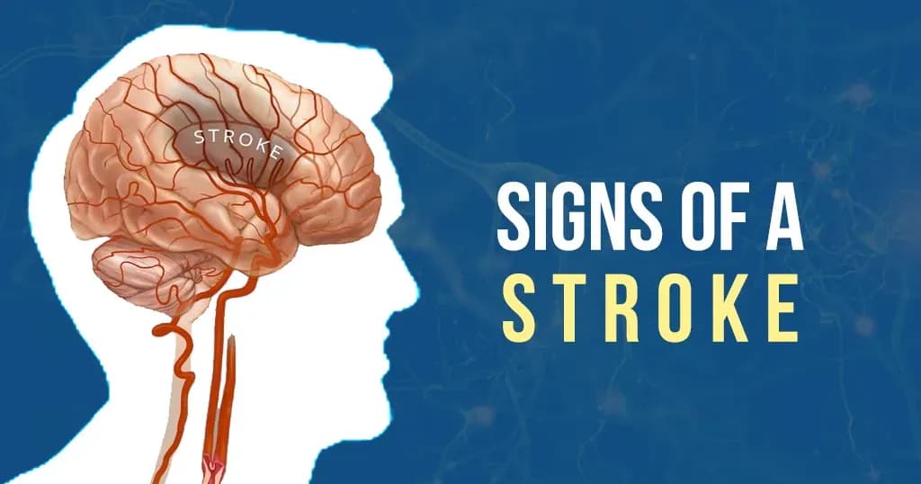 The FAST way to recognise a Stroke