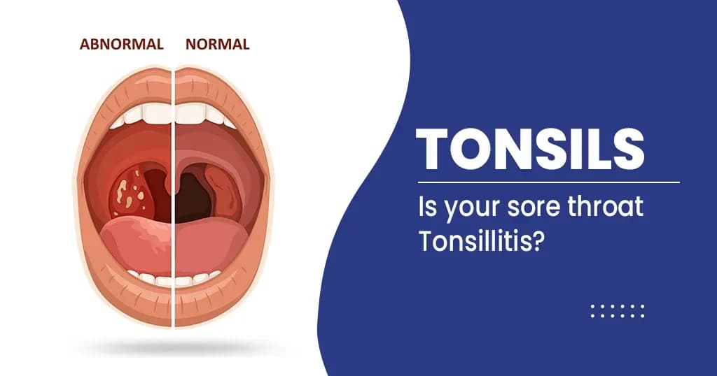 How well do you know your tonsils?