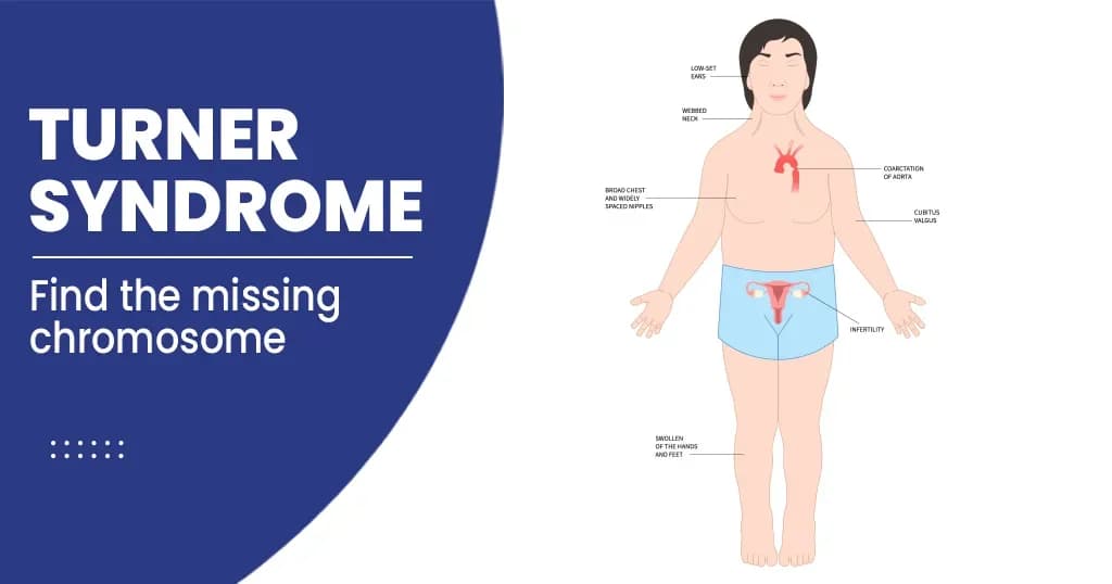 Turner’s syndrome – Types, Symptoms, Risk factors, and Treatments