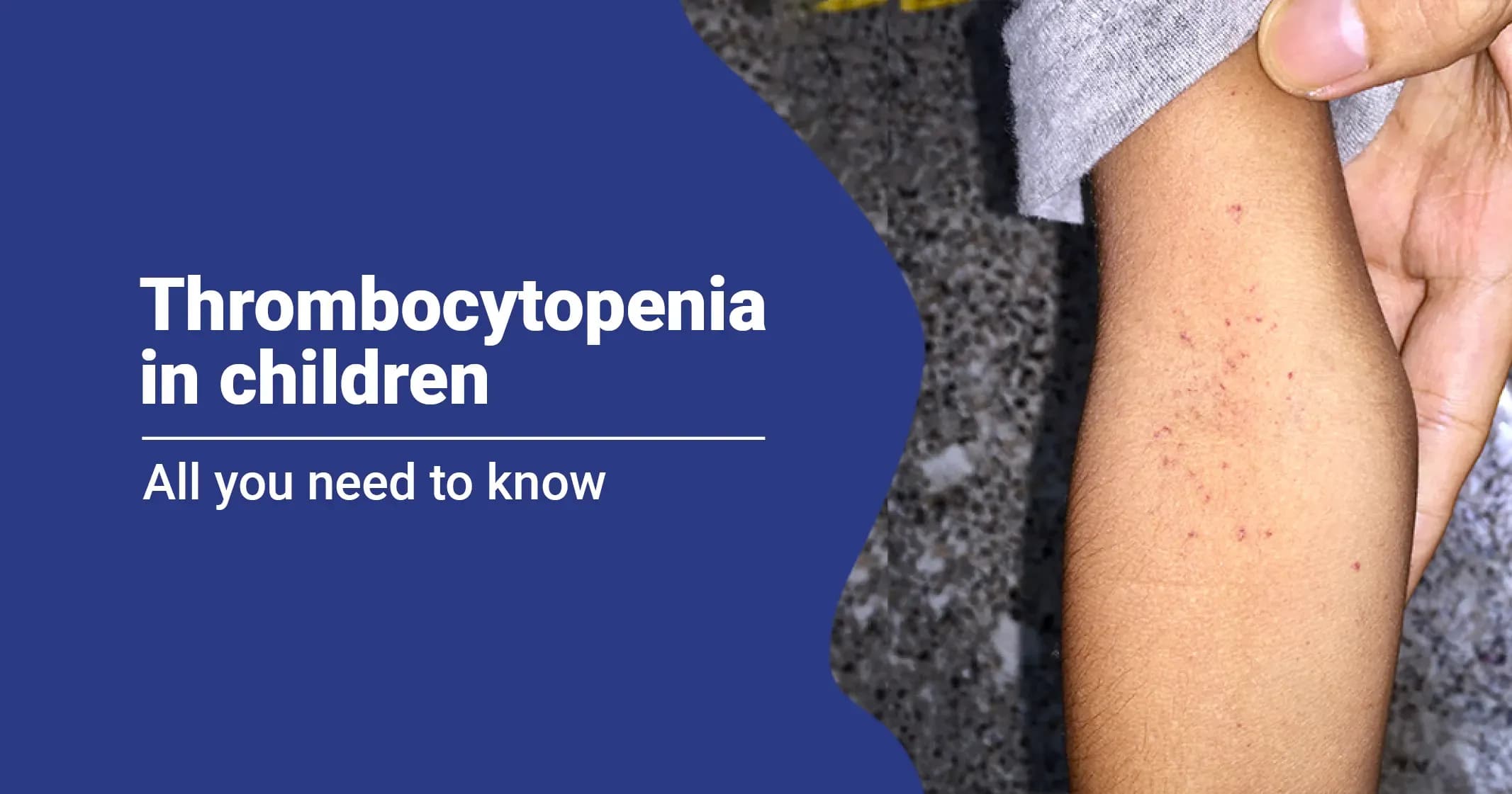 All you need to know about Thrombocytopenia in Children 