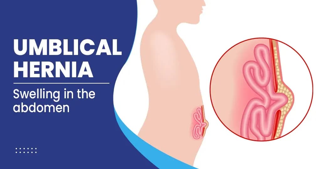 Umbilical Hernia- Symptoms, Risk factors, and more