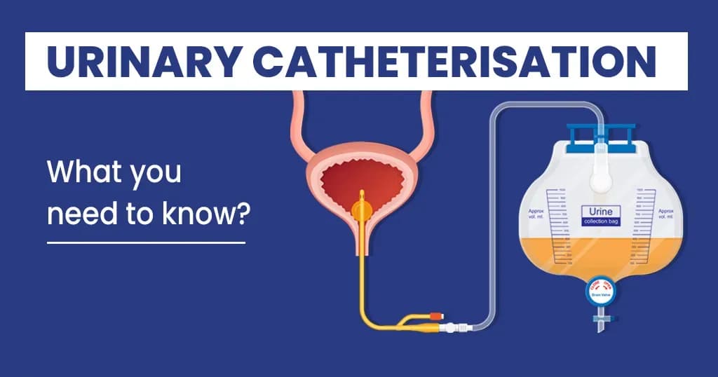 Urinary catheterisation – Uses, types and complications