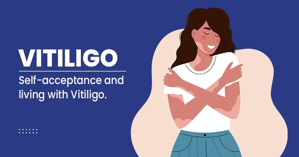 Vitiligo - Causes, Types and Management