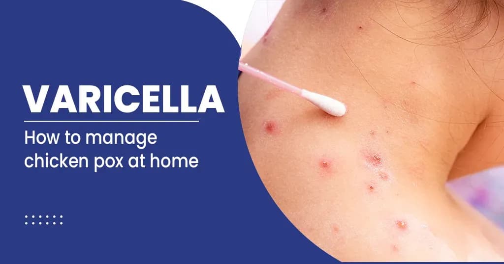 Chicken pox - Overview