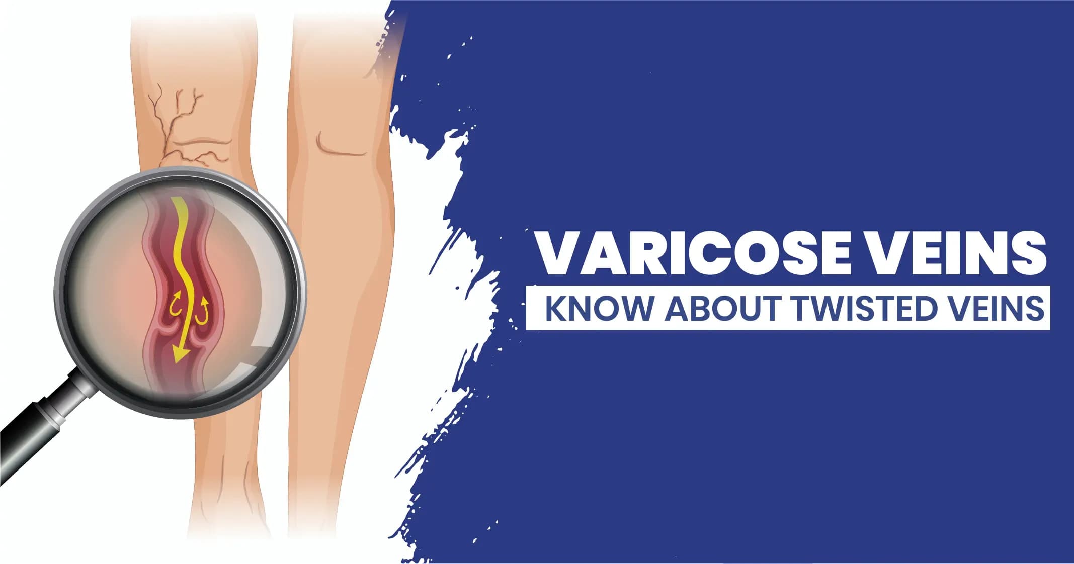 Varicose Veins - Diagnosis, treatment and causes