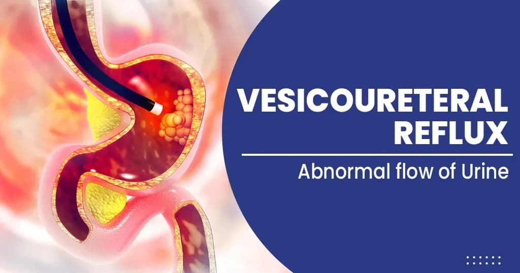 Vesicoureteral reflux - Overview, Symptoms, Causes, Treatments and More