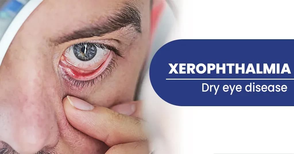 What is xerophthalmia (night blindness)?