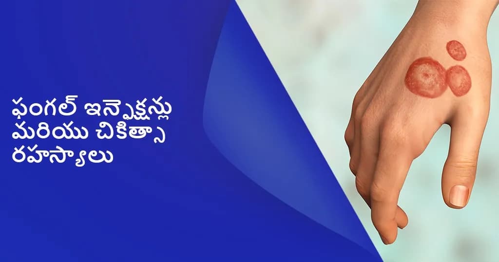 జుట్టు, చర్మం లేదా గోళ్లపై ఏర్పడేటటువంటి ఫంగల్ ఇన్ఫెక్షన్లు