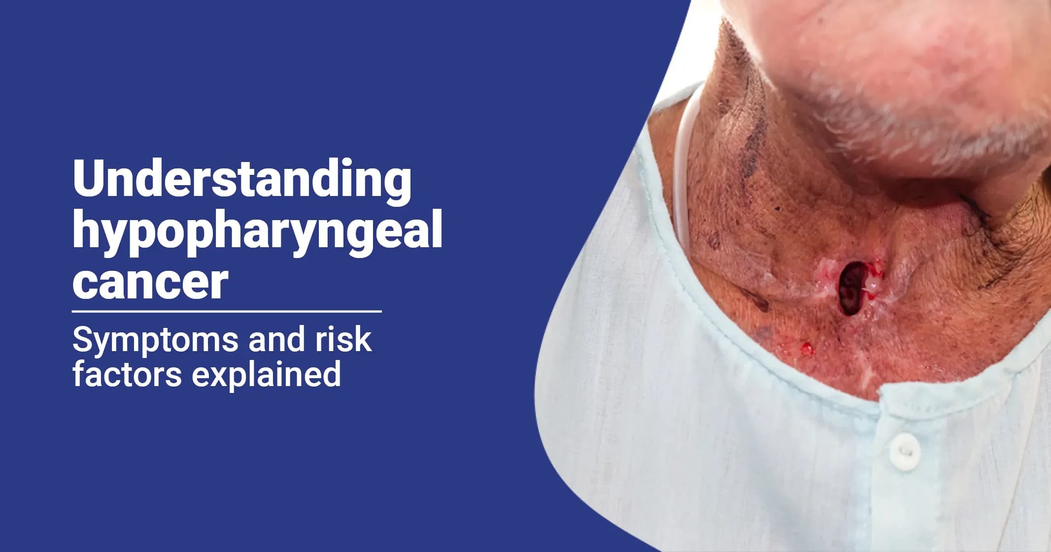 Understanding Hypopharyngeal Cancer