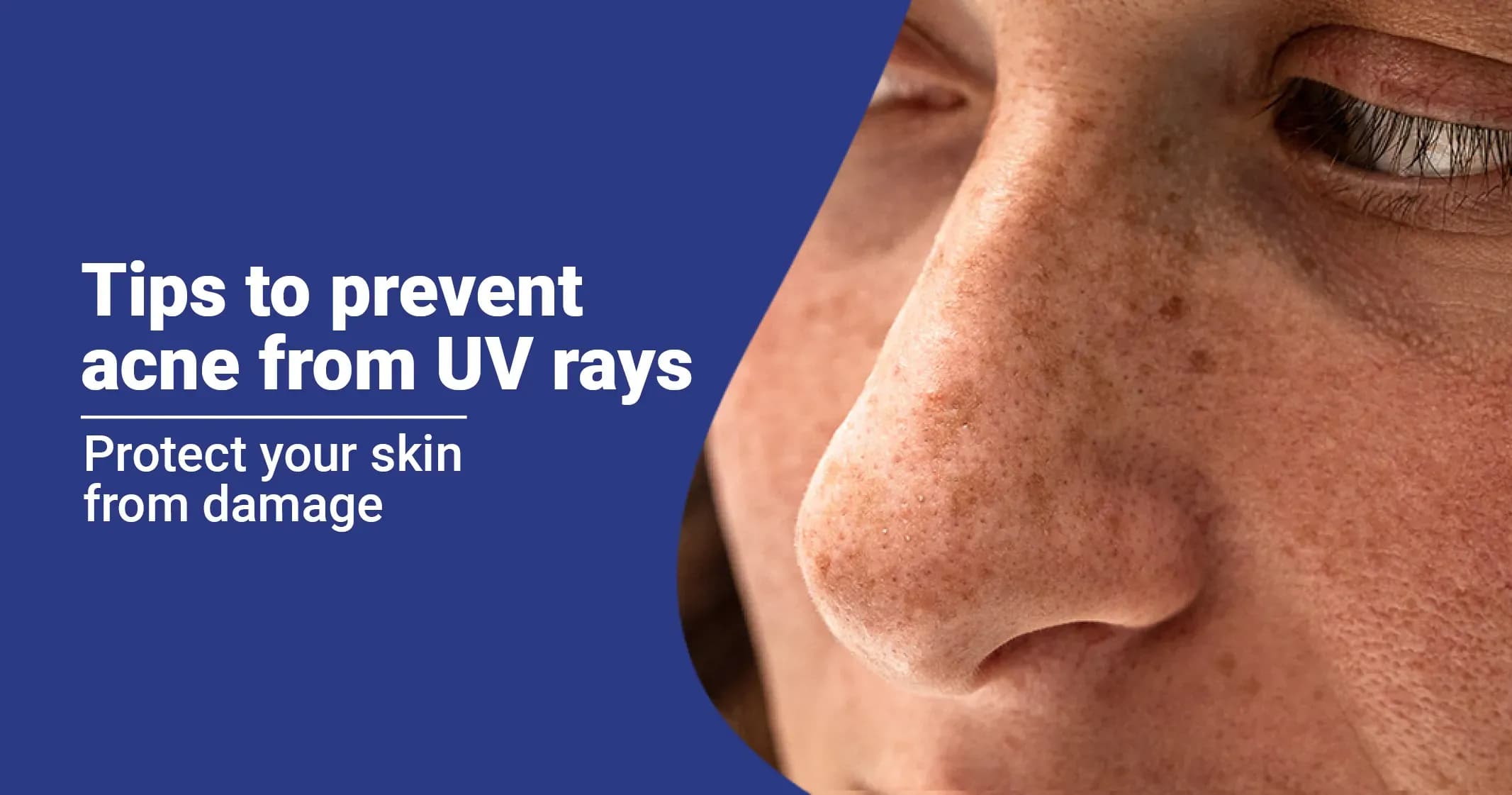 Ways to Prevent Acne caused by UV Rays