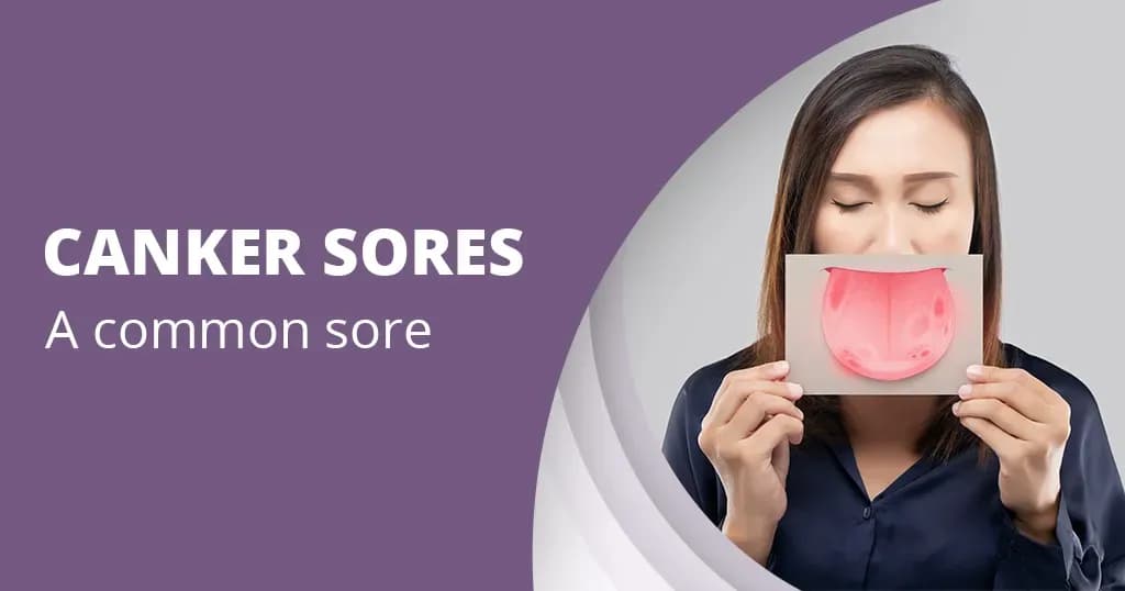 Canker Sores - What are they and how to get rid of them?