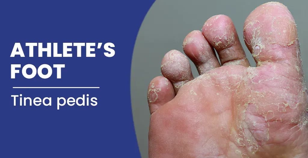 What is athlete's foot? - Symptoms, Risk Factors, and Treatment