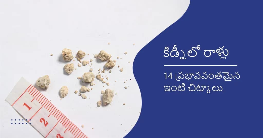 కిడ్నీలో రాళ్లు- 14 ప్రభావవంతమైన ఇంటి చిట్కాలు