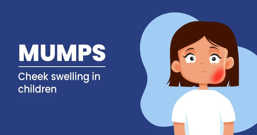 Mumps in children - Easy to get, easy to spread, easy to prevent