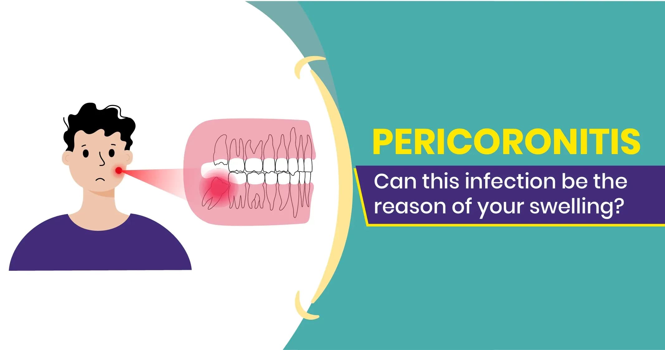 Pericoronitis - Symptoms, treatment and complications