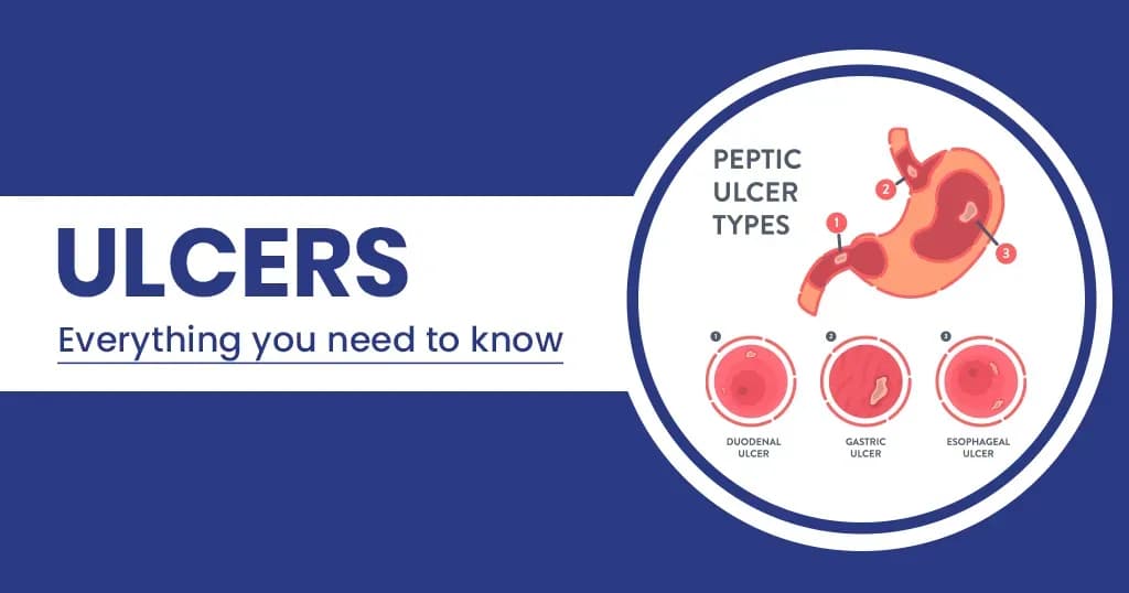 Types of Ulcers - Symptoms, Causes and Treatments