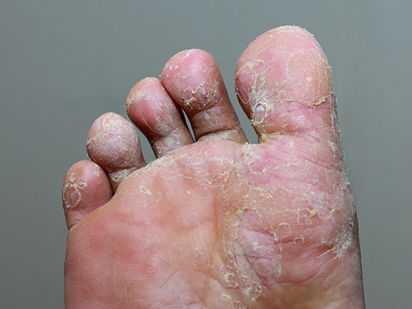 What Is Athlete S Foot Symptoms Risk Factors And Treatment