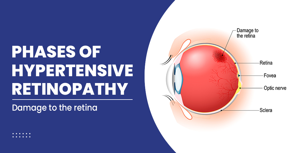 hypertensive retinopathy vs normal