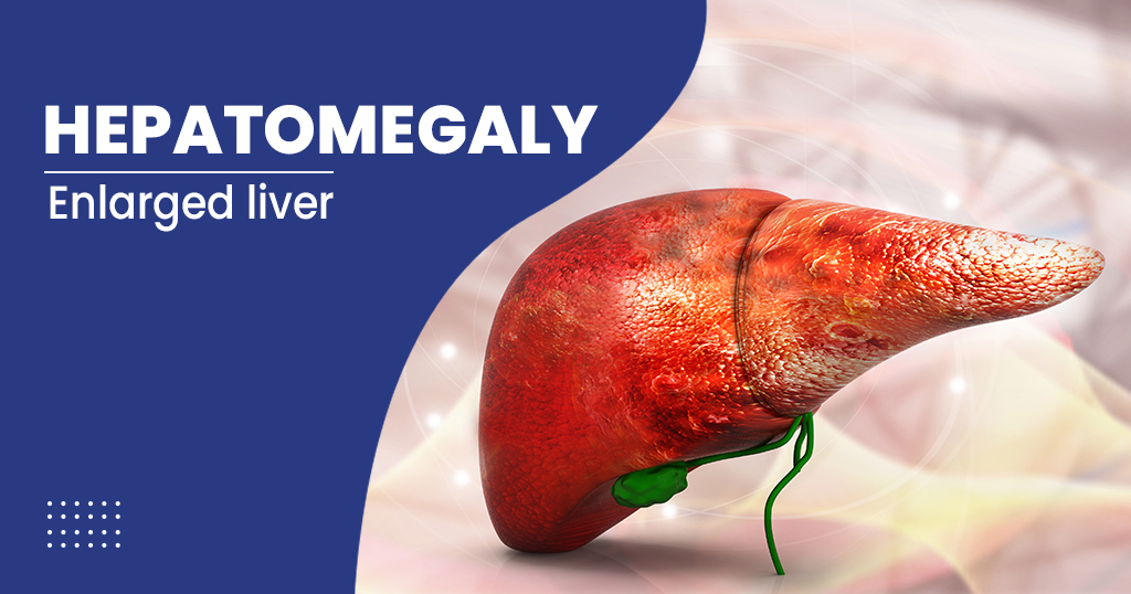 HEPATOMEGALY