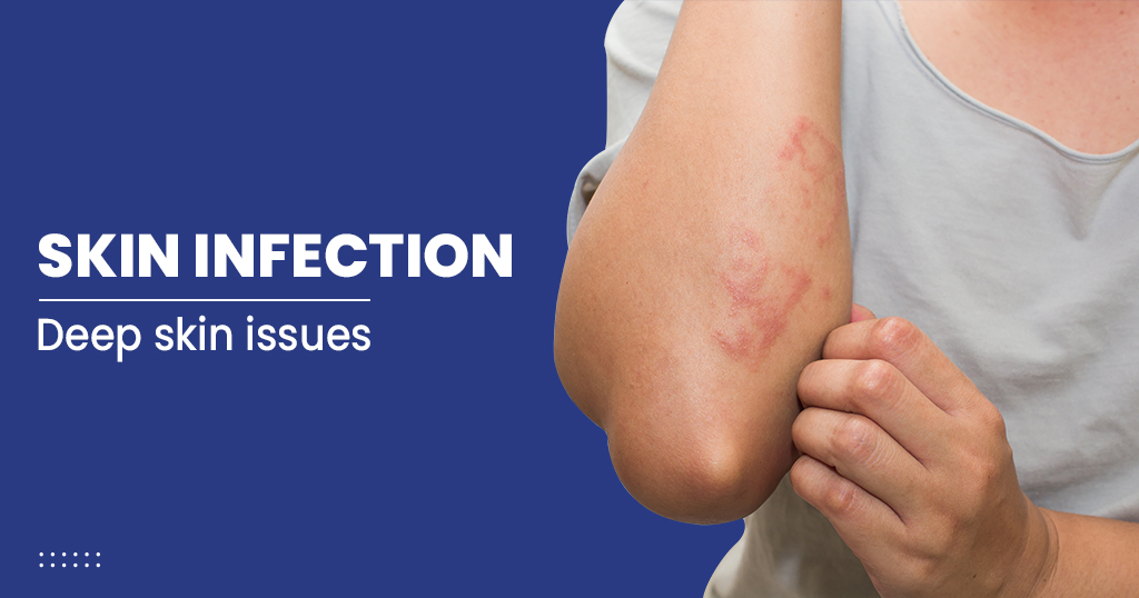 Skin infection – Causes, Symptoms, Treatments, and Risk factors