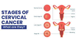 Stages of cervical cancer- Types