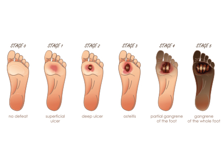 Stages of Diabetic Foot Ulcer