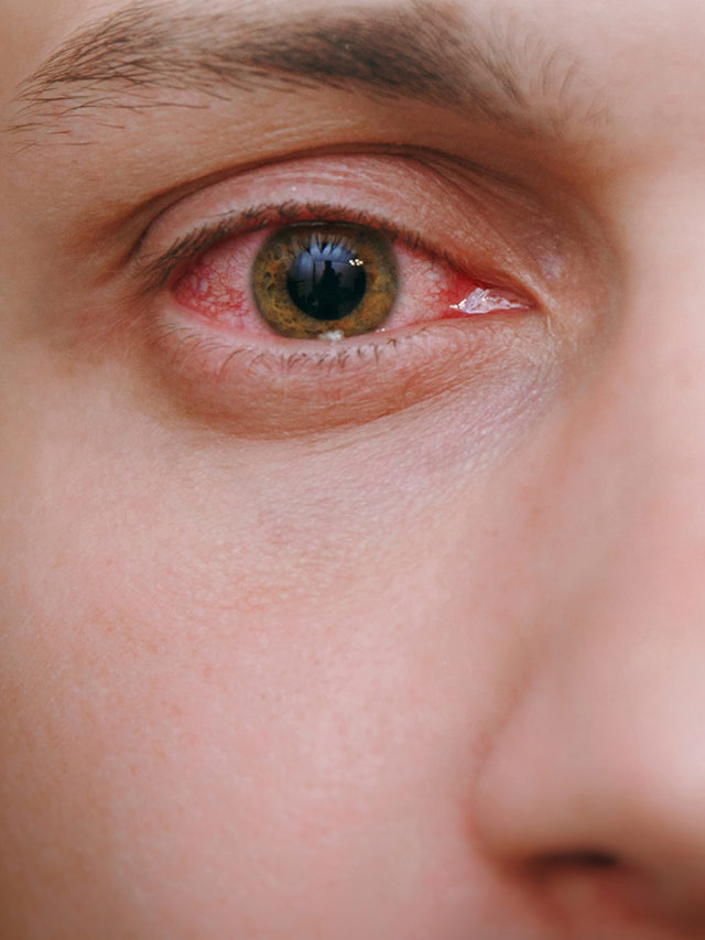 8 Symptoms of Pink eyes