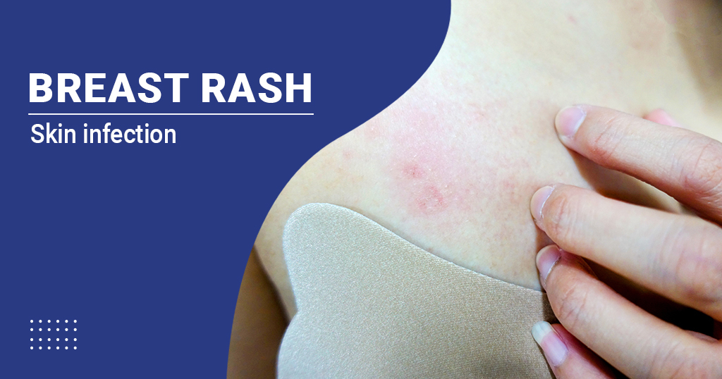Breast Rash – Causes, Symptoms and Treatment