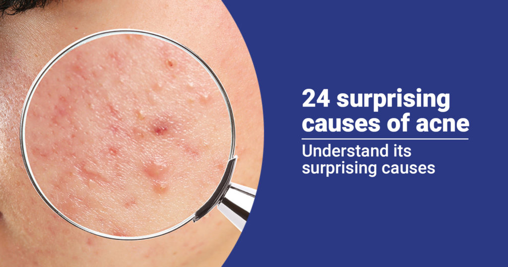 24 Surprising causes of acne