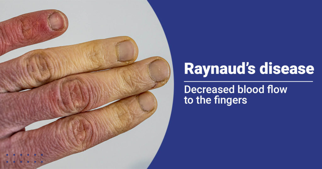 Raynaud's disease