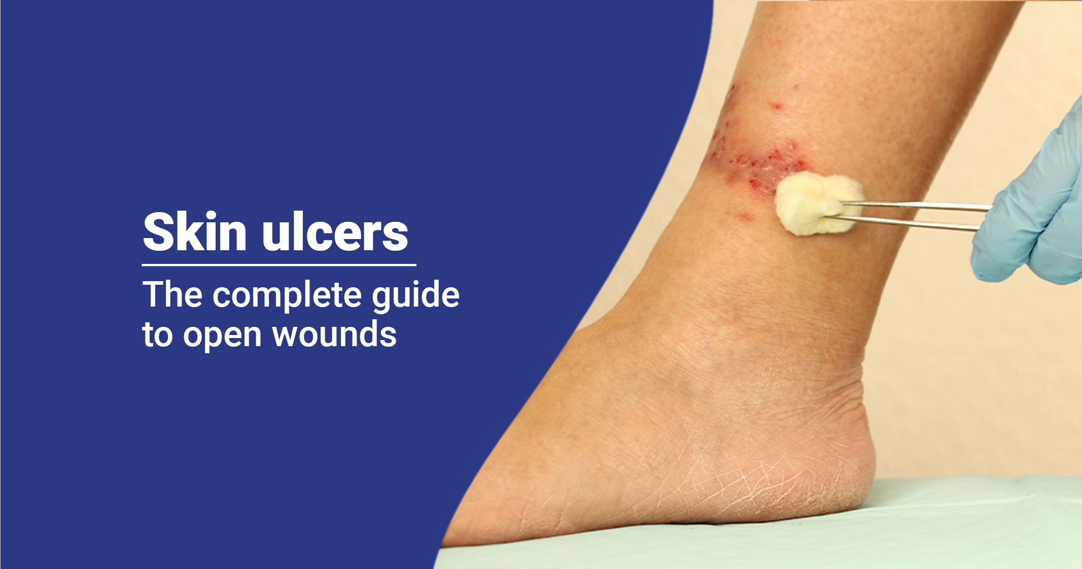 Skin Ulcers - Types, Causes, and Treatment