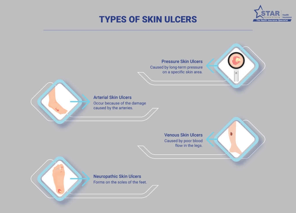 Skin ulcer types