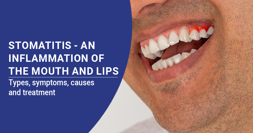 Stomatitis - An Inflammation of the Mouth and Lips