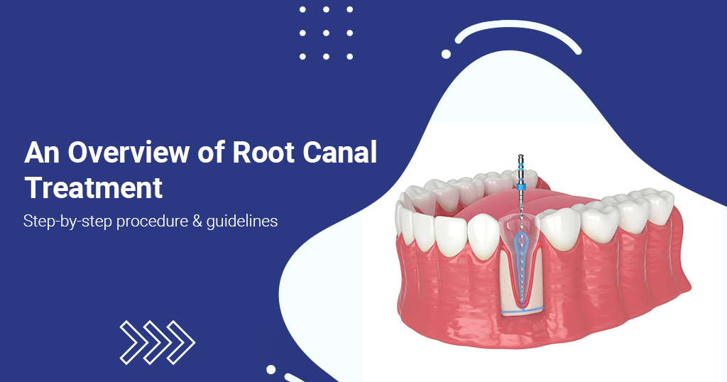 Root Canal Treatment: Step By Step Procedure And Guidelines