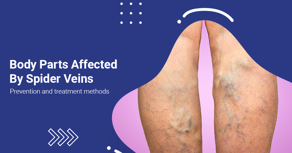 Which body parts are most affected by Spider Veins?