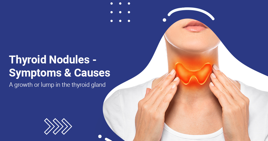 Thyroid Nodules - Symptoms & Causes